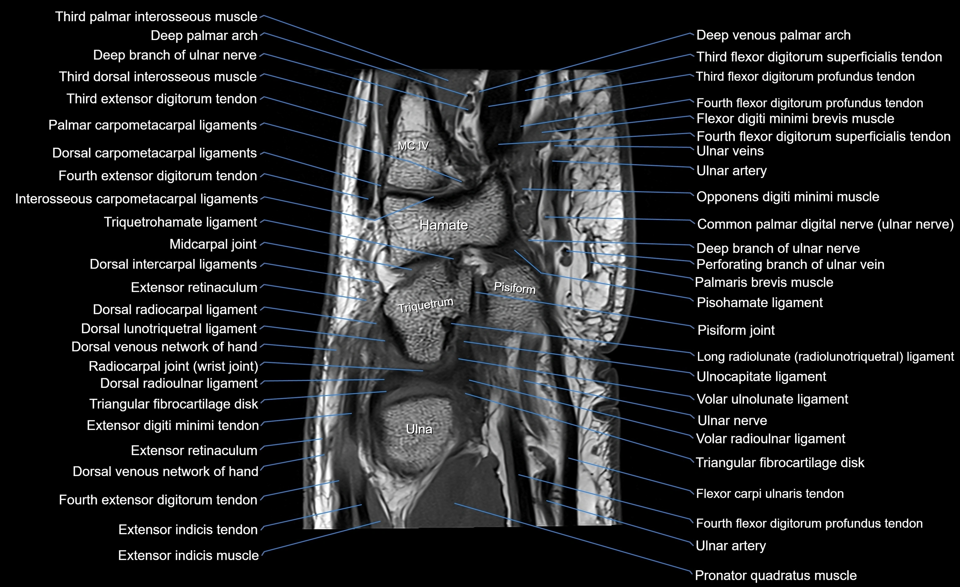 MRI wrist sagittal cross sectional anatomy 3T  radiology  image-img-00001-00018.webp